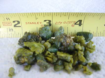 Cheryls Gallstones