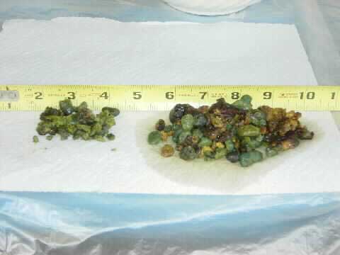 Gallstones