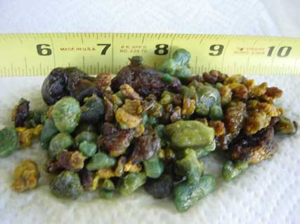 Genes Gallstones